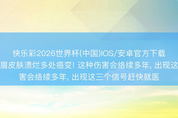快乐彩2026世界杯(中国)IOS/安卓官方下载 勾通喝了一年， 须眉皮肤溃烂多处癌变! 这种伤害会络续多年， 出现这三个信号赶快就医